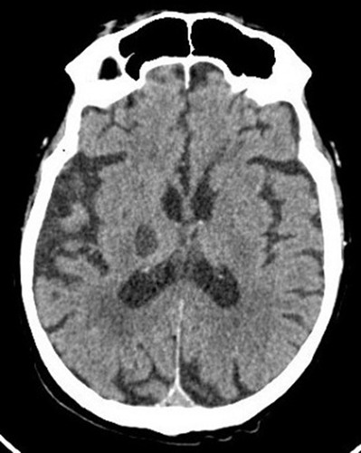 Figure 3 Cranial CT scan at 3 weeks.