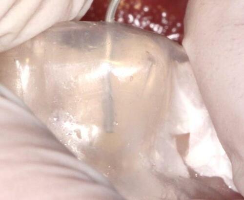 Figure 9 Tip of the injectable composite resin syringe inserted into the space created by the wax-up.