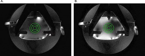 Figure 1 Birefringent pattern shown in the lens internal stress image with loose screw (A) and tight screw (B).