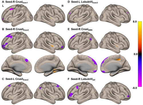 Figure 1. Differences in cerebellar-cerebral FC between the ESRD and the control groups (p < 0.05, FDR-corrected). altered FC of the R Crus IExec1 in ESRD (a). altered FC of the R Crus IExec2 in ESRD (B). altered FC of the L Crus IIExec2 in ESRD (C). altered FC of the L Crus IExec3 in ESRD (D). altered FC of the R Crus IDMN in ESRD (E). altered FC of the R Lobule VIAff in ESRD (F). L, left; R, right; FC, functional connectivity; ESRD, end-stage renal disease; FDR, false discovery rate.