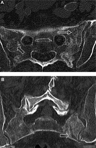 Figure 3 CT images of sacrum.
