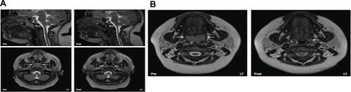 Figure S11 (A) Left 4 images. Mid sagittal (top) and axial T2-weighted images at the level of the nasopharynx (bottom), of a patient before (left) and after (right) adenotonsillectomy. Solid white arrows indicate adenoid tissue (gray) and dotted arrows indicate nasopharyngeal airway.Note residual adenoidal tissue and larger airway after adenoidal tissue and larger airway after adeniodectomy. In this example, a 29% reduction in adenoid volume was noted on MRI. (B) Right 2 images. Axial T2-weighted images at the level of the oropharynx of a patient before (left) and after (right) adenotonsillectomy. Solid white arrows indicate tonsillar tissue (gray) and dotted arrows indicate oropharyngeal airway. Note the larger airway and small left residual tonsil tissue after tonsillectomy.Note: Reprinted from CHEST, 142(1), Strauss T, Sin S, Marcus CL, Mason TBA, McDonough JM, Allen JL, et al., Upper airway lymphoid tissue size in children with sickle cell disease, 94-100, Copyright 2012, with permission from Elsevier.Citation50