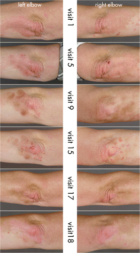 Figure 3 Treatment response over time. Left elbow: local treatment with calcipotriol, distant parts in combination with excimer laser. Visible benefits from the combined therapy regimen could be recorded from the first laser sessions on, rated as partial clearance from visit 5–17. Due to increasing erythema in visit 18 the total score was above 2. Right elbow: local treatment with dithranol, distant parts in combination with excimer laser. Also quick response to the combination therapy, rated as partial clearance from visit 5–16 and as total clearance at the follow‐up visits. The overall scores of local treatment alone were between 8–5.