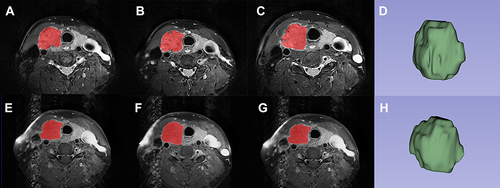 Figure 2 Representative example of the placement of volume of interest (VOI) on the papillary thyroid carcinoma (PTC) with BRAF V600E mutation. The red parts on the Axial T2-weighted images (A, B and C) are the PTC lesions segmented at several levels, and (D) is the three dimensional image of VOI; Axial contrast-enhanced T1WI (E, F and G) are the PTC lesions segmented at several levels, and (H) is the three- dimensional image of VOI.