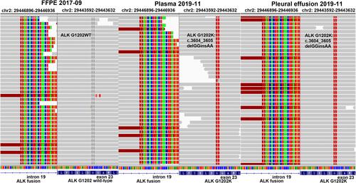 Figure 2 The identification of ALK-G1202K mutation. EML4: exon6~ALK: Exon20 fusion was detected in the tissue sample (NO: FB19AN0069), and no mutation of ALK-G1202K was found. Both EML4: exon6~ALK: Exon20 fusion and mutation of ALK-G1202K was detected in pleural effusion (NO: CA19AB0015) and plasma (NO: PA19AB0014) samples.