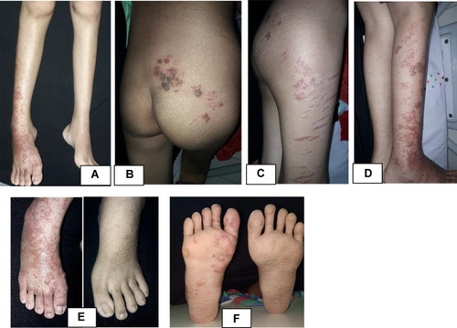 Figure 2 Dermatologic examination. Appearance of vesicles and some were confluent into bullae with erythematous base scattered on cruris dextra (A and D), lateral side of femur dextra (C), gluteus (B), and dorsum and plantar pedis dextra (E and F). Appeared striae on lateral side of right femur (C).