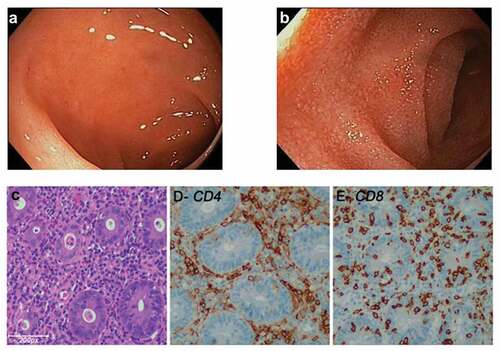 Figure 1. (a and b) Endoscopic revealed grossly normal mucosa in patients treated with anti-PD-1 and anti-CTLA-4 combination mAbs. (c) Hematoxylin and Eosin (H&E)-stained section of the colonic biopsy shows diffuse colitis with crypt atrophy and loss of crypts with residual inflamed lamina propria. A severe lymphoplasmacytic infiltration of the lamina propria with increased intraepithelial lymphocytes and crypt epithelial cell apoptosis is seen. (d and e) A severe CD4+ and CD8+ lymphocytic infiltration is seen in lamina propria. (e) Increased intraepithelial CD8+ lymphocytes (>10/100 enterocytes) and lymphocytic cryptitis are observed.