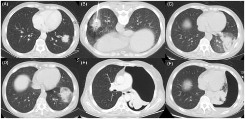 Figure 3. (A) Enhanced CT and MRI scan from case 3 showing a peripheral neoplasma 35 mm in diameter adjacent to an oblique fissure in the left lower lobe. (B) MWA was performed at a power of 70 W for an accumulated total time of 12 min. (C) CT follow-up scan at 48 h after MWA showing a GGO-like reaction band around the lesion encompassing the entire tumour. (D) CT scan on day 10 after MWA showing the stable GGO ablation zone. (E) Enhanced CT scan at 32 days after MWA showing a larger pneumothorax and atelectasis. (F) Follow-up CT scan at 2 months after MWA showing the formation of a bronchopleural fistula within the MWA cavitation that abutted the visceral pleura.