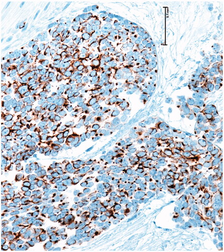 Figure 5. Positivity for cytokeratin 20.