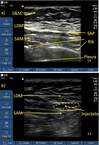 Figure 2. (a) Ultrasound caption of serratus plane prior to needle insertion. (b) Caption of serratus plane showing bupivacaine injection in the serratus anterior plane. S&SC: skin and subcutaneous, LDM: latissimus dorsi muscle, SAM: serratus anterior muscle, SAP: serratus anterior plane.