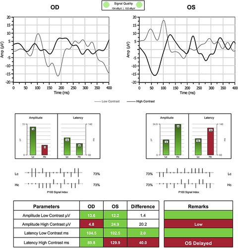 Figure 3 Visual evoked potential: Decreased amplitude with high contrast test stimuli OD and increased latency of high contrast test stimuli OS. Red color cells outside normative ranges. Green cells are within normative ranges.