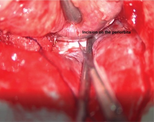 Figure 7 Intraoperative image showing the incision being made on the periorbita.