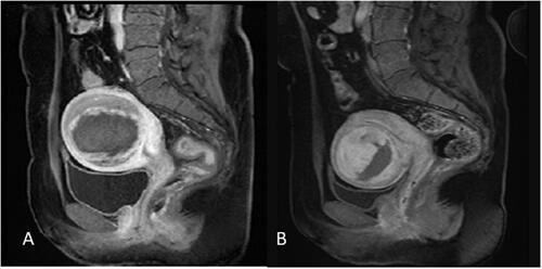 Figure 5. Contrast-enhanced MRI obtained from a patient with uterine fibroids in recurrent group. (A) One day post-USgHIFU image showed a NPV ratio of 62% was achieved. (B) 6-month post-USgHIFU image showed local recurrence of the treated fibroid.