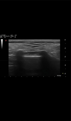 Figure 1. Ultrasound image showing the two sacral corn with the sacrococcygeal membrane and the sacral canal in between.