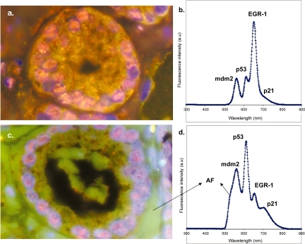 Figure 6 Multiplexed QD staining of archived FFPE clinical specimen from human prostate cancer patients, and comparison between two different glands on the same tissue specimen. Four tumor biomarkers (mdm-2, p53, EGR-1 and p21) were labeled with four colors of QDs emitting at 565 nm, 605 nm, 655nm, and 705 nm respectively. (a) Color fluorescence image of QD-stained tissue specimens showing just one gland; (b) representative fluorescence spectrum obtained from single cells in the gland (image a); (c) color fluorescence image of the same QD-stained tissue specimens but showing a different gland; (d) representative fluorescence spectrum obtained from single cells in the second gland (image c). Note that the biomarker profile is remarkably different for different glands. This ability to measure cellular heterogeneity on the same tumor specimen will be crucial for clinical applications. AF stands for autofluorescence.