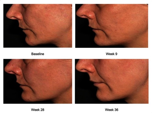 Figure 7 Subject’s photographs at baseline and at weeks 9, 28, and 36 exhibiting overall skin quality improvements after treatment with CPM®-HA20G.