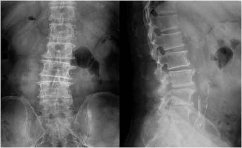 Figure 1 The anteroposterior and lateral X-ray images of a 68-year-old woman diagnosed with lumbar spinal stenosis. The T-scores of L1-L4 in the 68-year-old woman were −0.8, 0.4, 1.9 and 3.4, respectively. She had 3 abnormal segments with unreliable T-scores whose absolute value of T-score differences were all more than 1.0. From the anteroposterior and lateral X-ray images of the patient, we could observe obvious degenerative changes such as vertebral osteophytes and abdominal aortic calcifications, especially at lower segments.