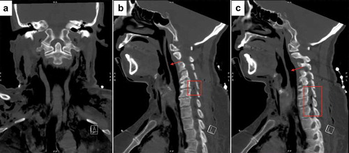 Figure 2. CT scan of the neck without contrast (a) Coronal slice, bone window, revealing diffuse subcutaneous emphysema from the mediastinum extending into lower neck soft tissues. (b) and (c) Sagittal slices, bone window, revealing diffuse subcutaneous emphysema from the mediastinum extending into the retropharyngeal space (red arrow) and epidural air in the spinal canal spanning C6-T1 (red box)