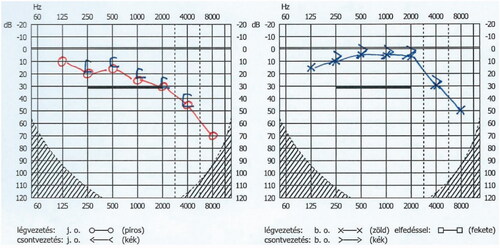 Figure 4. After intratympanic steroid treatment, a control audiometry was performed. The treatment was effective, because a 30 dB improvement in the hearing status was achieved.
