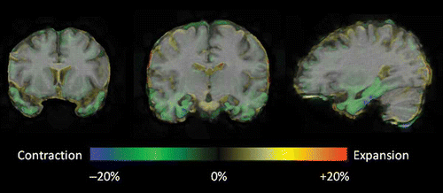 Figure 3. Representative coronal and sagittal MRI slices with voxel deformation mapping overlay, over an interval of 4 years post-presentation. These demonstrate relatively focal bilateral contraction (green/blue = volume loss) in the temporal lobes, particularly involving the temporal poles, parahippocampal and fusiform gyri, with an anterior–posterior gradient. [To view this figure in colour, please see the online version of this Journal.]