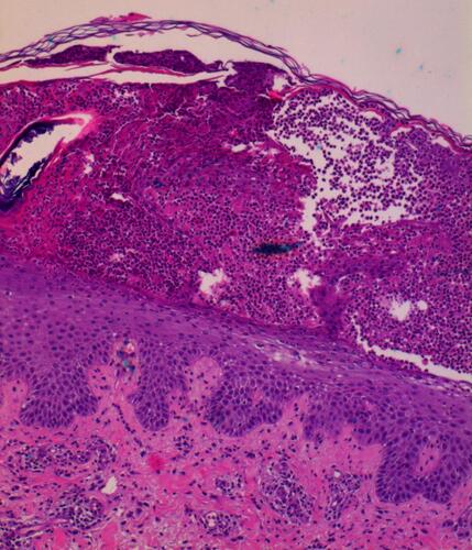 Figure 2 Histopathological findings of lesional skin biopsy showing intraepidermal spongiform pustule consisting of accumulated neutrophils in an acanthotic, hyperkeratotic and parakeratotic epidermis. The dermis showed a sparse perivascular mixed inflammatory infiltrate (x100, hematoxylin and eosin [H&E]).
