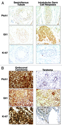 Figure 5. Hedgehog pathway member immunohistochemical expression profiles in embryonal carcinoma, teratoma, and testis. Gli1, Ptch1, and Ki-67 (a proliferation marker) immunohistochemical expression patterns are displayed in (A) a representative histopathologically normal seminiferous tubule vs. intratubular germ cell neoplasia and (B) a representative embryonal carcinoma vs. adjacent teratoma. All panels are shown as 100× magnification.