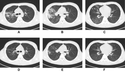 Figure 6 A 15-year-old male patient with DS-TB. CT scan on 28 May 2017 showed multiple exudative and proliferative lesions in both lungs, which had predominant right upper lung lobe involvement (A–C). A CT scan on 17 September 2017 revealed that bilateral lesions were significantly reduced (D–F). The predicted value of the model was 0.10257, and the result was predicted as drug sensitivity, which was in agreement with DST.