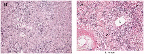 Figure 1. Storiform fibrosis and obliterative phlebitis. (a) Storiform fibrosis: spindle‐shaped cells, inflammatory cells and fine collagen fibers are forming a flowing arrangement. The infiltration of plasma cells is easy to recognize. Eosinophils are also intermingled (hematoxylin and eosin stain). (b) Obliterative phlebitis: fibrous venous obliteration with inflammatory cells (arrows). L:lumen.