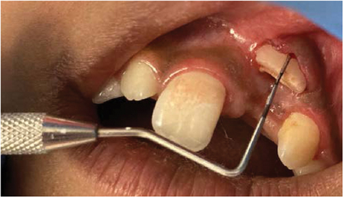 Figure 4. Appointment 2 after gingivectomy.