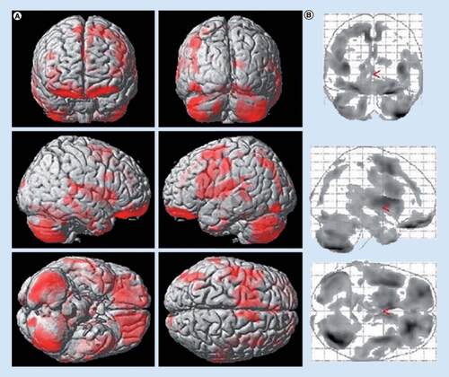 Figure 2. Progression of brain atrophy in Parkinsonian variant of multiple system atrophy in comparison with Parkinson’s disease.There was no progression of brain atrophy in the Parkinson’s disease cohort and marked progression of brain atrophy in the Parkinsonian variant of multiple system atrophy cohort in regions including the striatum, midbrain, thalamus and cerebellum, as well as cortical regions such as the primary sensorimotor cortex, supplementary motor area, lateral premotor cortex, medial frontal gyrus, middle frontal gyrus, orbitofrontal cortex, insula, posterior parietal cortex and hippocampus (A) overlay onto a rendered brain surface; (B) glass brain view.Modified with permission from [Citation15].