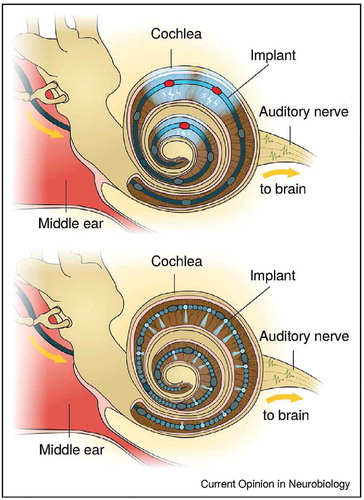 Figure 1. Differences between electrical and optical stimulation in the inner ear. An optical implant can stimulate more locations in the cochlea, as optical spread can be confined by the nature of the light source or with additional focussing elements. Reprinted from Moser (Citation2015) with permission from Elsevier. © Elsevier. Reproduced by permission of Elsevier. Permission to reuse must be obtained from the rightsholder.