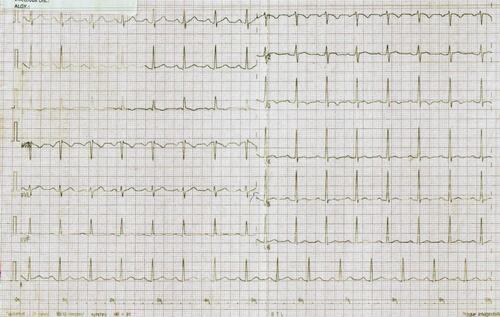 Figure 3 EKG showing normal sinus rhythm following electrical cardioversion.