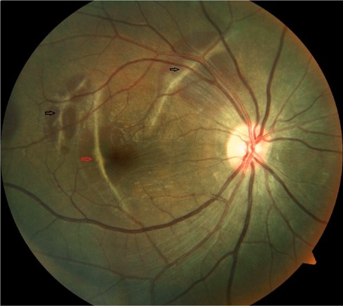 Figure 1 Fundus photo right eye showing multiple indirect choroidal ruptures with sub-retinal blood (black and red arrows).