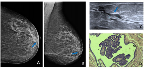 Figure 2 Solitary dilated duct with round calcifications (blue arrow) at cranio-caudal (CC) (A) and at medio-lateral oblique (MLO) (B) left mammogram view; ultrasound (US) shows intraductal heterogeneous intraductal content (blue arrow) (C). H&E staining (x10) shows papilloma (D).