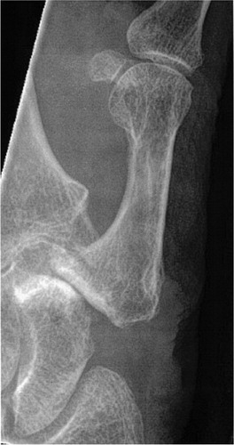 Figure 1. Subsidence of the metacarpal against the scaphoid 3 years after LRTI with APL.