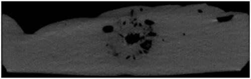 Figure 3. Unenhanced CT scan of an ex-vivo liver specimen after microwave irradiation at 40 W for 5 min, acquired before cutting it for the gross-pathologic examination.