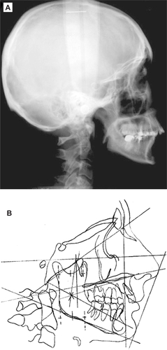 Figure 8 Cephalometric radiograph (A) and tracing (B) of the patient six years after chemoradiotherapy.