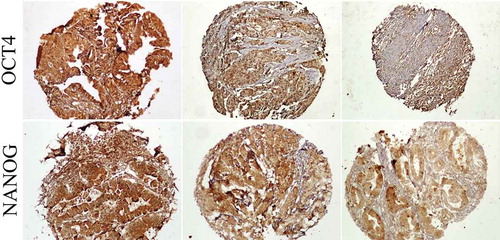 Figure 2. Expressions of OCT4 and NANOG in colorectal cancer tissues. In each type of marker, the intensity of staining was shown as strong (+3), moderate (+2), and weak (+1) staining (from left to right)