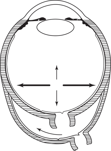 Figure 2 Intraocular forces in an elongated globe act further back and are directed more sideways.