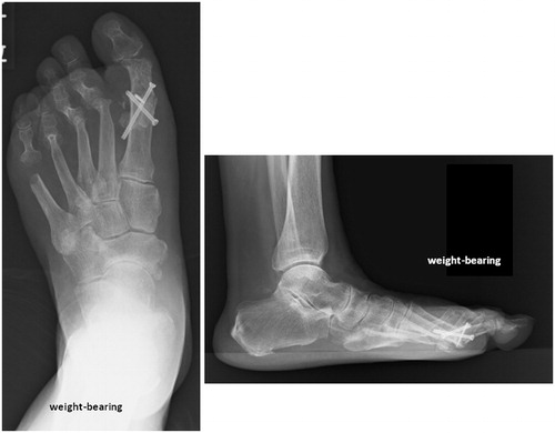 Figure 6. Postoperative X-ray of the affected foot. The MTP-1 joint is re-fused in the proper rotational position. Improvements in the pronated deformity and the sesamoid position are seen (Hardy grade 2).