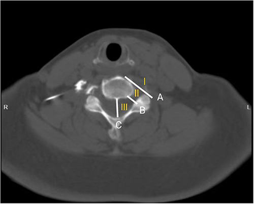 Figure 3 The injection distribution area in the cross section of CT image: Line A is from anterolateral vertebral body to the lateral margin of the facet. Line B is from posterior-lateral vertebral body to the interior margin of the facet. Line C is the axial centerline of the epidural space. Zone I The out space of line A is extra-foraminal; Zone II: Between line A and B is the foraminal spaces; Zone III: Between line B and C is intra-foraminal/epidural spaces.