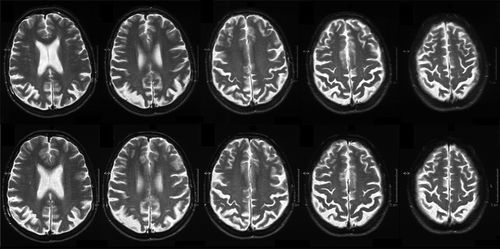 Figure 1. CG’s brain imaging. A selection of axial slices from brain MRI scan performed at the first assessment (top) and follow-up visit about one year later (bottom), where focal and increasing bi-parietal cortex atrophy is clearly visible.