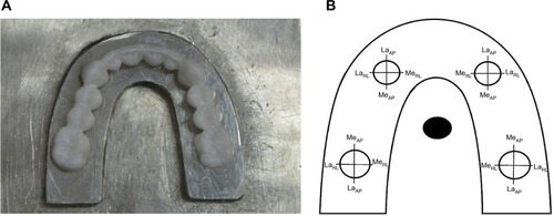 Figure 2 Measurement of marginal discrepancy of full-arch restoration for master metal model (A) at the medial (Me) and lateral (La) sides of each abutment in the anterior–posterior (AP) and right–left (RL) direction (B).