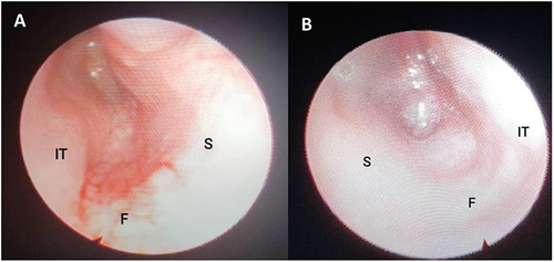 Figure 2 Nasal endoscopic images of the right (A) and left (B) nasal cavities demonstrate atretic plates in the posterior aspects of the nasal cavities bilaterally.