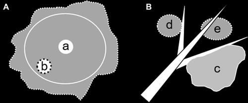 Figure 2 CT manifestations of type I and II GGNs. (A) Type I GGN is defined as a regular (marked by white solid line) or irregular (marked by white dotted line) GGO containing an internal centric (a) or eccentric (b) high-attenuation zone. (B) Type II GGN is defined when one nodule edge abuts an adjacent blood vessel, and the length of this edge close to the vessel is more than or equal to two-thirds of the nodule’s long diameter on the same section (c). The GGNs locally cling to the blood vessels (d) or surrounding the blood vessels (e) could not be seen as type II lesions.