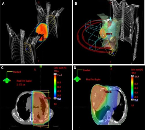 Figure 2 Radiotherapy planning images, illustrating how dose distributions around the planning target volume varies depending on the delivery technique used.