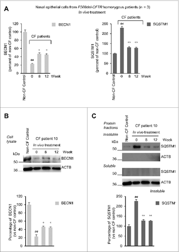 Figure 7. Effects of in vivo treatment on BECN1 and SQSTM1 protein levels in nasal brushing from F508del-CFTR homozygous patients. (A) Effects of treatment on BECN1 (left) and SQSTM1 (tight) protein levels in freshly isolated nasal epithelial cells of patients No. 5, 6 and 10 of Table 1. The values are expressed as percentage of non-CF healthy control (considered as 100% of value). Mean ± SD of triplicates of independent experiments per each patient's sample; ##p < 0.01 compared to non-CF healthy control, °P < 0.05 and °°P < 0.01 versus wk 0 (ANOVA). (B and C) Representative blot of 1 patient (No. 10 of Table 1) out of 3 patients analyzed. (B) Western blot analysis of cell lysates and immunoblot with anti-BECN-1 (Abcam); (C) Western blot analysis of insoluble and soluble protein fractions and immunoblot with anti-SQSTM1 (Sigma Aldrich). ACTB was used as negative marker of the insoluble protein fraction and as loading control of the experiment. Bottom, densitometric measurement of (B) BECN-1 and (C) SQSTM1 levels expressed as percentage of non-CF healthy control. Mean ± SD of triplicates of independent experiments; ##P < 0.01 compared to non-CF healthy control, °P < 0.05 and °°P < 0.01 versus wk 0 (ANOVA).