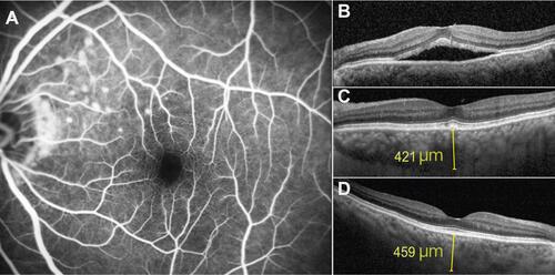 Figure 4 A patient with high-risk features for persistent central serous chorioretinopathy (CSCR). (A and B) A 51-year-old man was referred to our hospital because of an 18-week history of persistent CSCR in the left eye (OS). He discontinued using nasal steroids at least 8 weeks prior to the referral. Fluorescein angiogram demonstrated multiple spots of leakage hyperfluorescence in the superonasal macula. (C) He received a 6-week course of 400 mg/day ketoconazole, which resulted in resolution of CSCR at 7 weeks visit. (D) Baseline subfoveal choroidal thickness in the right eye was thicker than that in OS (459 and 398 µm).