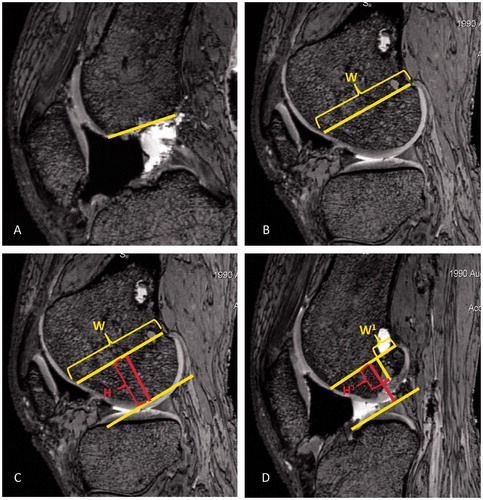 Figure 4. Femoral measurements were made on sagittal MR images of the lateral femoral condyle using modifications to the quadrant technique described by Bernard et al. [Citation4]. First, the most proximal aspect of the femoral notch was identified, correlating to Blumensaat’s line (A). Next, the maximum sagittal width along Blumensaat’s line (W) was identified, measured, and copied to all images (B). The most distal aspect of the lateral femoral condyle was then identified and a line drawn tangential to that point. The perpendicular distance from Blumensaat’s line to this line was the notch height, H (C). Lastly, the slice at which the AM or PL tunnel broke the subchondral bone of the lateral femoral condyle was identified. Measurements were made perpendicular to lines W and H in order to locate the center of the tunnel. The center of the tunnel was expressed as a percentage along Blumensaat’s line and the notch height, displayed as W1 and H1, respectively (D).