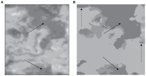 Figure 4 (A) Original image and (B) segmentation using our unsupervised strategy. The arrows indicate the isolated lesions. The split arrows indicate zones which are not lesions.